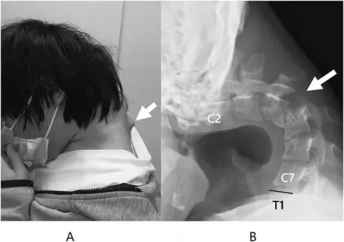 ▲日本男子頸椎因划手機變形位移，長出類似角的形狀出來。（圖／翻攝自Science Direct）
