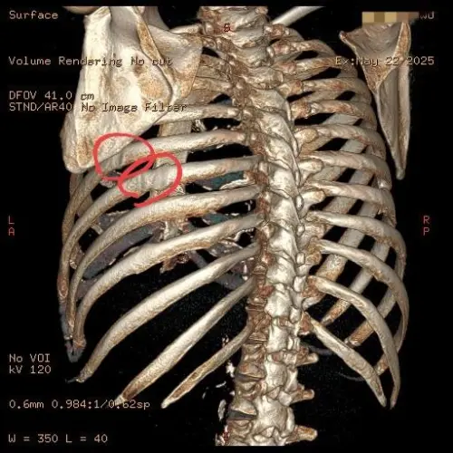 ▲40多歲的男性因為確診新冠咳嗽，某天咳嗽時聽到「啪一聲」，透過X光才看見肋骨斷裂。（圖／蘇一峰提供）