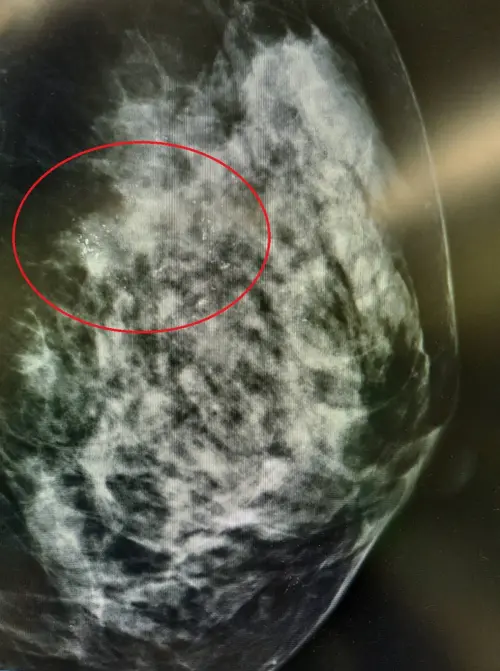 ▲張小姐乳房攝影檢查發現有瀰漫性微小鈣化點。（圖／台北慈願提供）