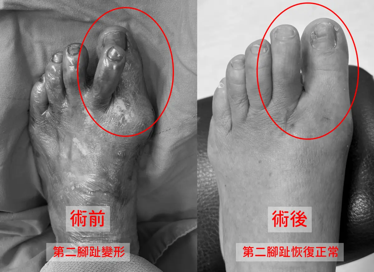 ▲患者長期拇指外翻，甚至情況愈來愈嚴重，出現變形而翹起來。（圖／中醫大新竹附醫提供）