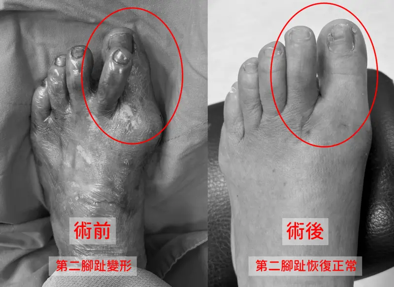 女拇指外翻！腳趾長厚繭「變形翹起」　醫示警：沒治療恐害脫臼