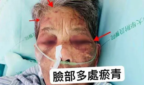 獨/臥床阿嬤鼻青臉腫竟是外傭下重手!家屬痛斥「比惡魔可怕」 ▲8旬老婦遭外傭打得鼻青臉腫。(圖/投訴人提供)