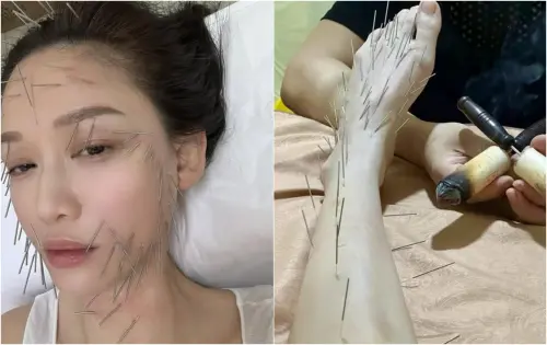 ▲陳喬恩「全身插滿針」原因曝光！公開駭人照認了：痛還是會痛的（圖／陳喬恩IG）