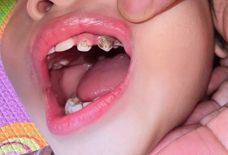 ▲牙齒發黑未必是蛀牙，可能是放射線菌感染。（圖／徐維敏醫師提供）