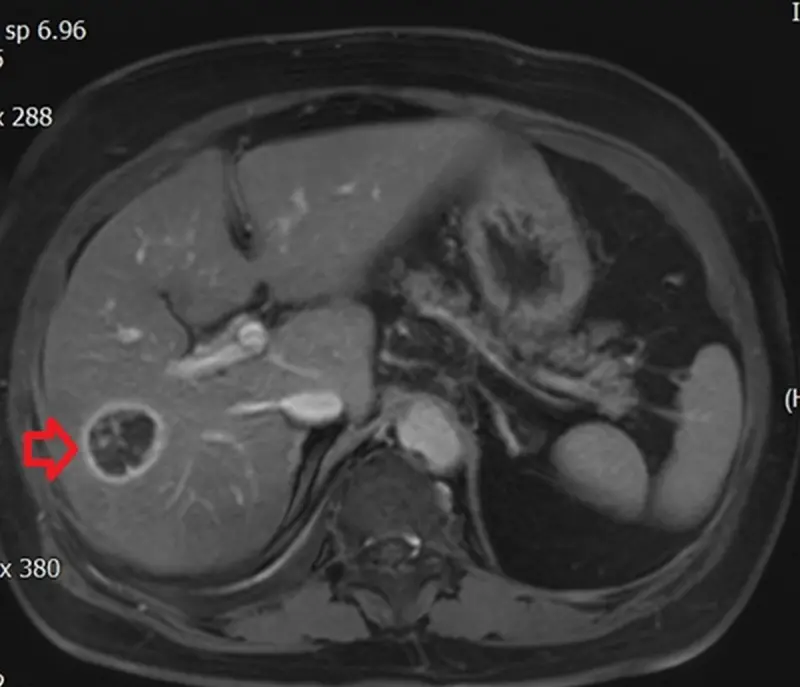 ▲許女士的腹部電腦斷層檢查顯示肝臟有3公分大腫瘤，確診為肝癌，經射頻燒灼術治療後平安返家。（圖／台北慈院提供）