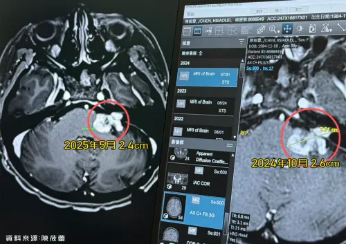 陳筱蕾2024年腦瘤2.6公分,今年5月照MRI發現腫瘤變小0.2公分了。(圖/年代提供) ▲陳筱蕾2024年腦瘤2.6公分,今年5月照MRI發現腫瘤變小0.2公分了。(圖/年代提供)