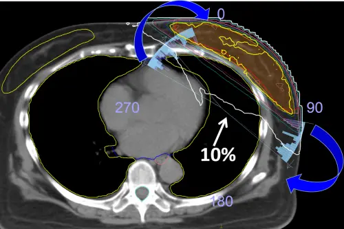 ▲以小角度動態調控射束方向(藍色圓弧),可將治療劑量集中在腫瘤區域,有效保護心、肺。(圖/台北慈院提供) ▲以小角度動態調控射束方向(藍色圓弧),可將治療劑量集中在腫瘤區域,有效保護心、肺。(圖/台北慈院提供)