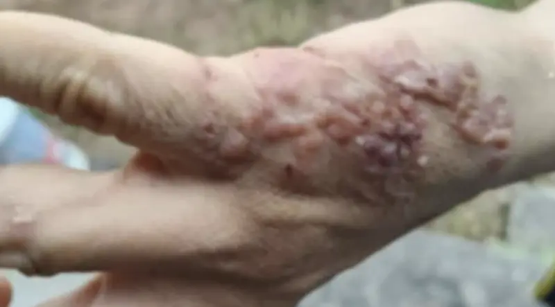 ▲一名泰國男子手部罹患奇怪水泡，醫生透露怪病發生原因。（圖／翻攝自X）