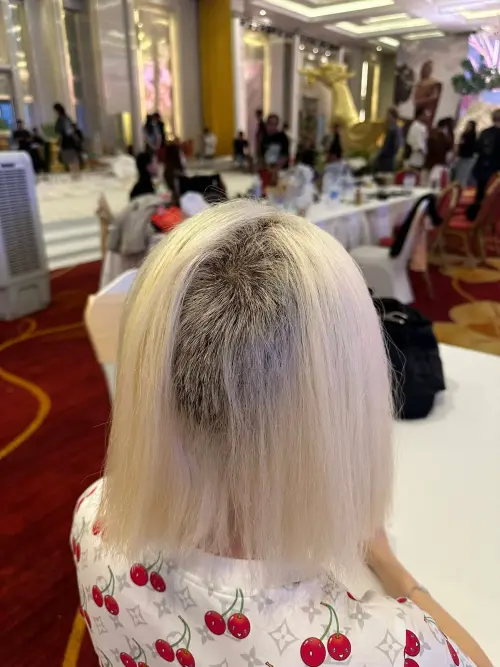 ▲SODA透露，自己目前頭上大部分區域的頭髮，只有3mm左右的長度，這樣的長度也無法進行接髮。