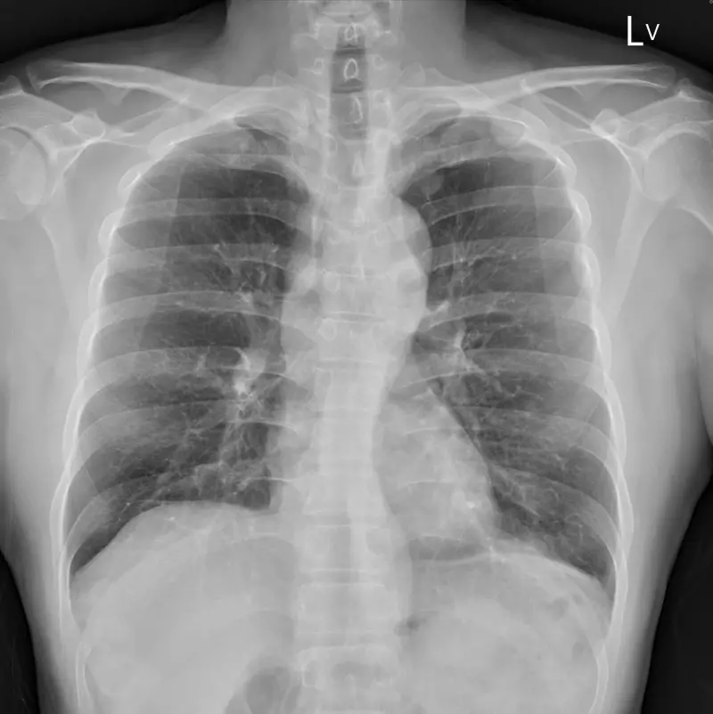 ▲一名4旬男沒有任何不舒服，健檢去年正常、今年卻發現已癌末。（圖／翻攝自蘇一峰臉書粉專）