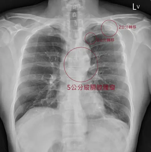 ▲一名4旬男沒有任何不舒服，健檢去年正常、今年卻發現已癌末。（圖／翻攝自蘇一峰臉書粉專）
