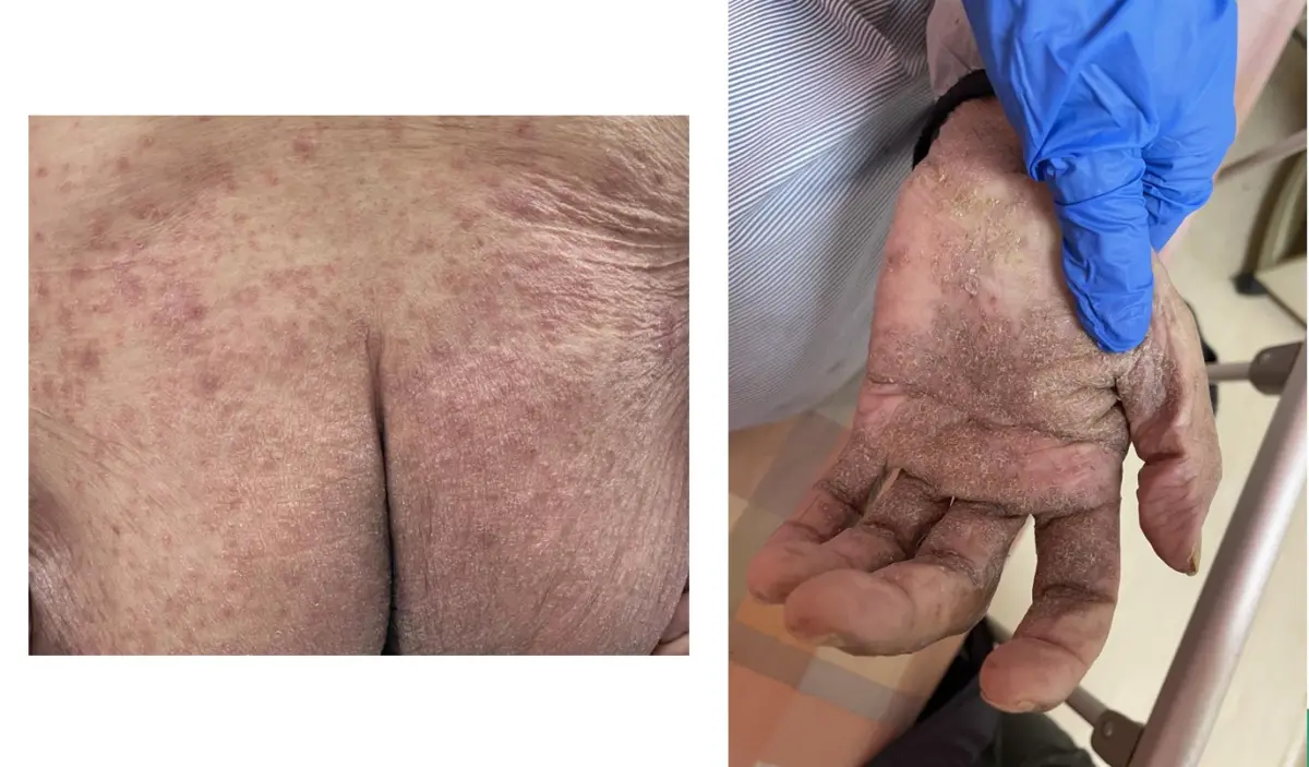 ▲個案因結痂型疥瘡感染，全身有多處抓痕與紅色丘疹，手掌也有明顯的厚痂。（圖／台北榮總提供）
