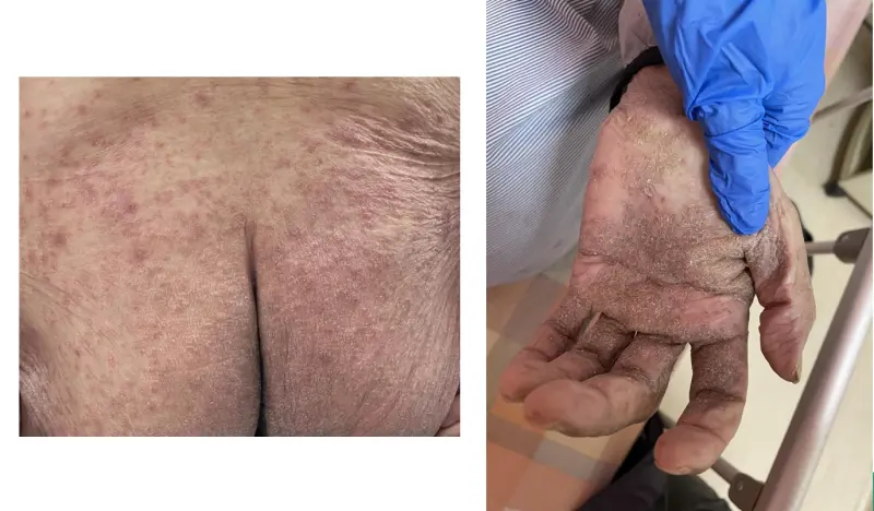 ▲個案因結痂型疥瘡感染，全身有多處抓痕與紅色丘疹，手掌也有明顯的厚痂。（圖／台北榮總提供）
