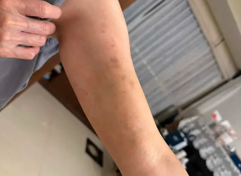 ▲ 有民眾指控去醫院看診，卻在未被充分告知下，一個月內打完6針類固醇，之後出現副作用，只是量血壓微血管就破裂出血。（圖／當事人提供）