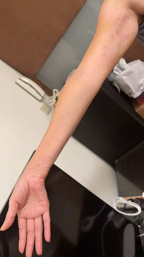 ▲ 有民眾指控去醫院看診,卻在未被充分告知下,一個月內打完6針類固醇,之後出現副作用,只是量血壓微血管就破裂出血。 ▲ ▲ 有民眾指控去醫院看診,卻在未被充分告知下,一個月內打完6針類固醇,之後出現副作用,只是量血壓微血管就破裂出血。(圖/當事人提供)