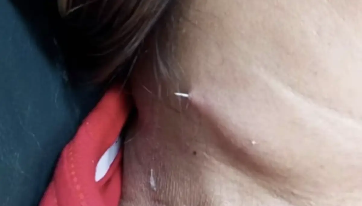 ▲泰國女吞嚥魚刺，結果魚刺竟然從頸部穿透而出。（圖／翻攝自臉書）