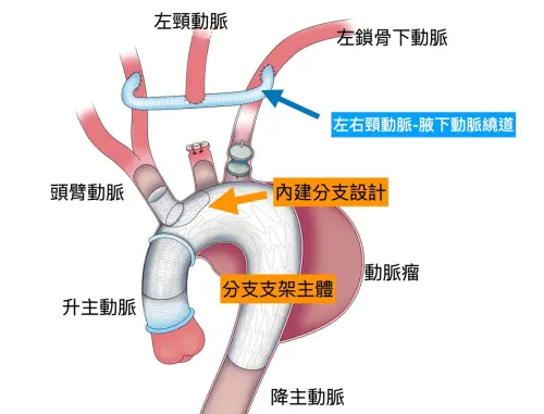 ▲胸主動脈分支支架示意圖。(圖/長庚醫院提供) ▲胸主動脈分支支架示意圖。(圖/長庚醫院提供)