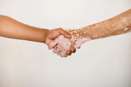 ▲白斑症（Vitiligo）又稱白癜風，是一種皮膚失去黑色素的疾病，會導致身體出現明顯的白色斑塊。（圖／取自Pexels）