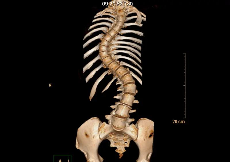 ▲21歲個案因為嚴重脊椎側彎，導致心肺功能受壓迫，稍微一活動就呼吸困難、喘。（圖／台中榮總提供）