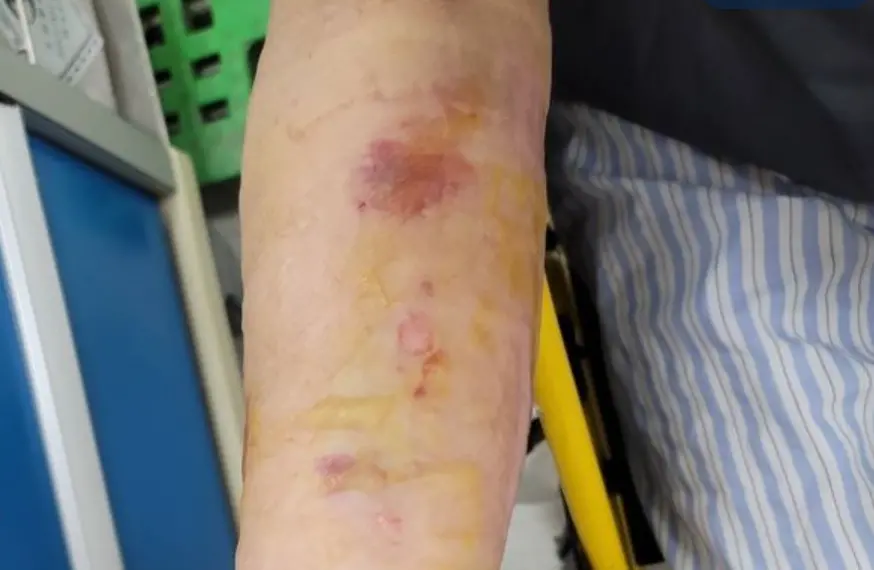 ▲一名中年婦女用蒜泥塗抹傷口造成潰爛，險些引起蜂窩性組織炎。（圖／雙和醫院提供）