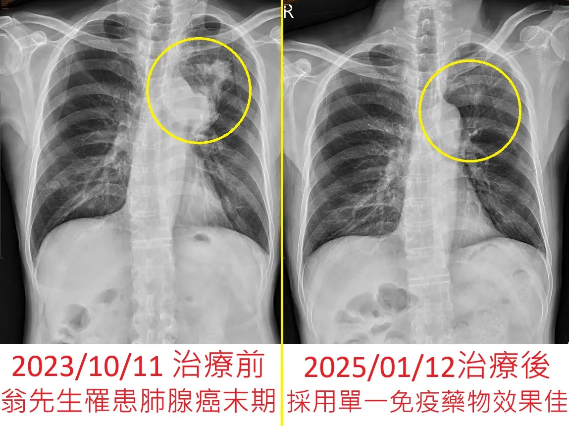▲有患者經常打破杯子與盤子，醫師檢查後確認罹患肺腺癌末期且有腦轉移。（圖／烏日林新醫院提供）