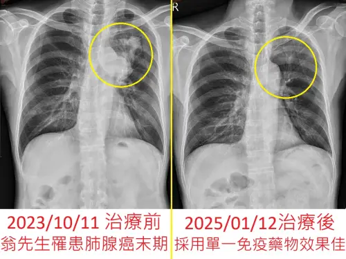 她頻打破杯盤!不菸不酒「肺腺癌末期」腦轉移 醫驚:哥哥也得