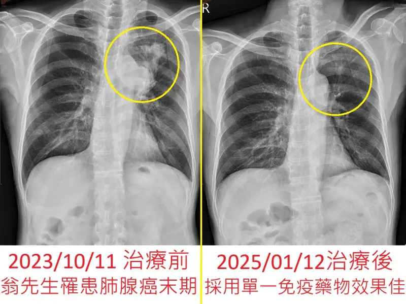 她頻打破杯盤！不菸不酒「肺腺癌末期」腦轉移　醫驚：哥哥也得
