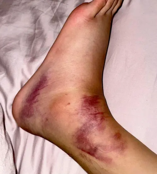 ▲洪暐哲練舞受傷，韌帶撕裂腳部腫脹嚴重。(圖／年代整合行銷提供)