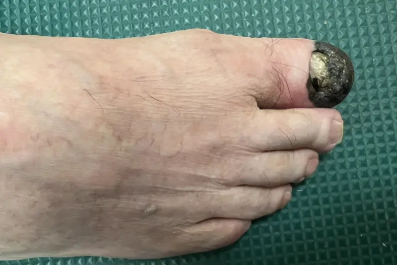 ▲一名76歲患者發現右腳大拇指出現一小塊深黑色痕跡，原以為瘀血，醫院檢查發現是「肢端黑色素瘤」。（圖／台北慈濟醫院提供）