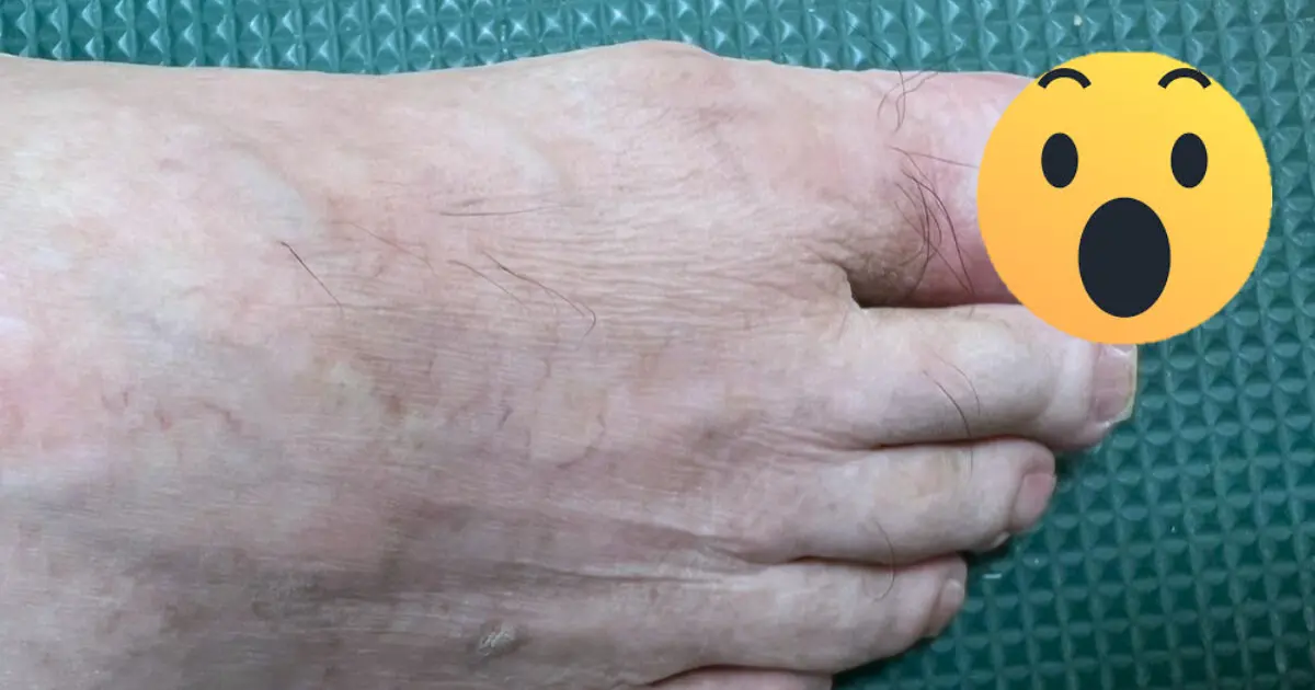 ▲一名76歲患者發現右腳大拇指出現一小塊深黑色痕跡，原以為瘀血，醫院檢查發現是「肢端黑色素瘤」。（圖／台北慈濟醫院提供）