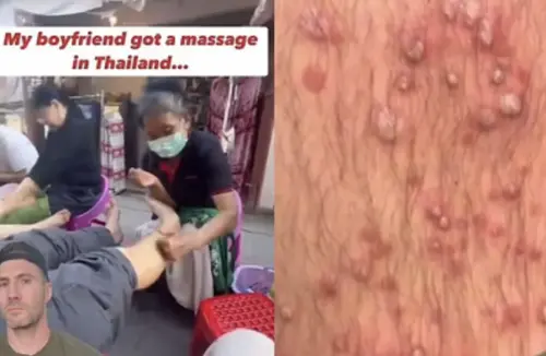 醫師懷疑男子是受到「金黃色葡萄球菌」感染。(圖/翻攝自Instagram) ▲醫師懷疑男子是受到「金黃色葡萄球菌」感染。(圖/翻攝自Instagram)