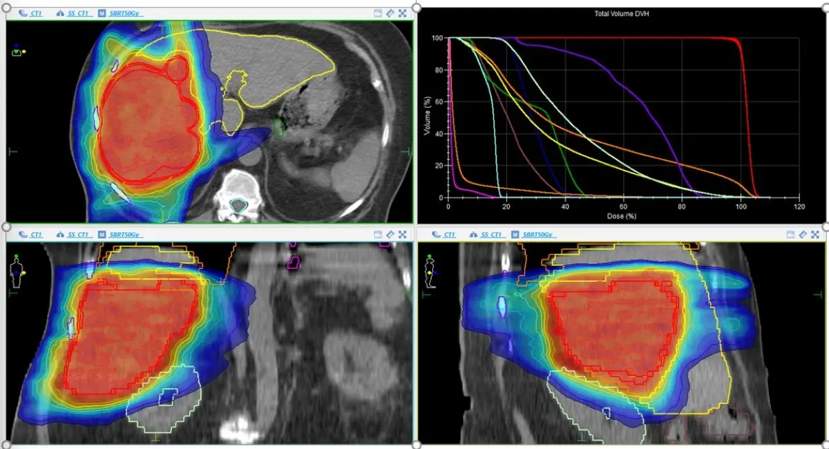 ▲在SBRT治療中，從3個角度及劑量體積圖可見，高劑量集中於腫瘤區，周邊正常的肝、腎皆獲良好保護。（圖／台北慈院提供）