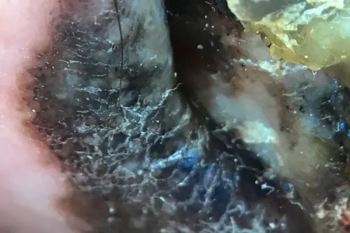 ▲在皮膚鏡高倍顯像下，惡性黑色素瘤的黑色素顏色深淺不一，腫瘤邊緣不規則。（圖／台北慈院提供）