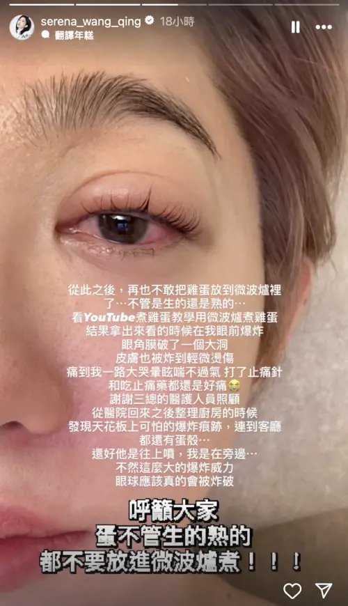 ▲王晴用微波爐煮雞蛋受傷。（圖／王晴IG）