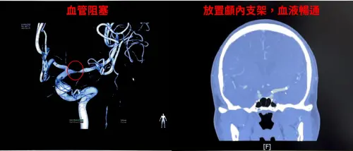 ▲50歲中年男性因突發性右側肢體無力，到醫院急診就醫時，確認為年輕型中風。（圖／中醫大新竹附醫提供）