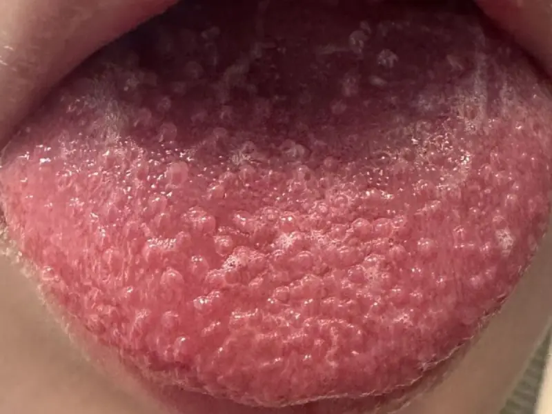 ▲男童出現典型的草莓舌症狀，確診為猩紅熱。（圖／台北慈院提供）