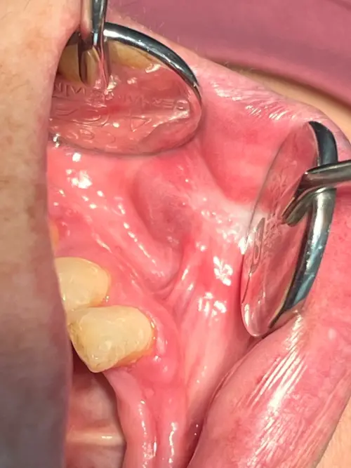 ▲▼良性口腔血管病變常在舌、頰黏膜、口底等部位出現紅紫或藍紫色外觀(上圖),經冷凍槍治療後完全消失(下圖)。(圖/長庚醫院提供)