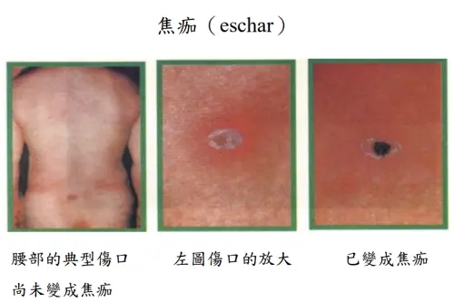 ▲焦痂是恙蟲病叮咬處形成的黑色壞死組織。（圖／翻攝自疾管署）
