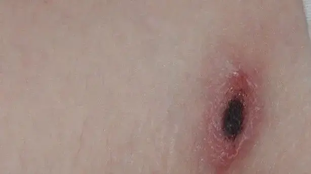 ▲恙蟲病為第4類法定傳染病，症狀除高燒與頭痛外，常合併結膜充血、咳嗽、淋巴結腫大與皮膚紅疹，約數日後會在衣物遮蔽處出現焦痂。（圖／台北市衛生局提供）