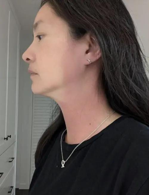 ▲Janet上個月突然冒出大片紅腫，查不出病因。（圖／摘自Janet FB）