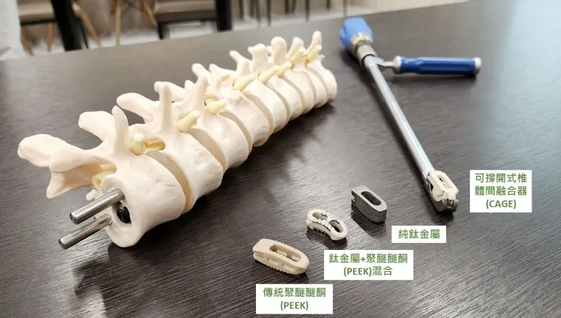 ▲可撐開式椎體間融合器可在椎間可靈活調整角度及高度，減少滑移風險並提高手術成功率。（圖／奇美醫院提供）