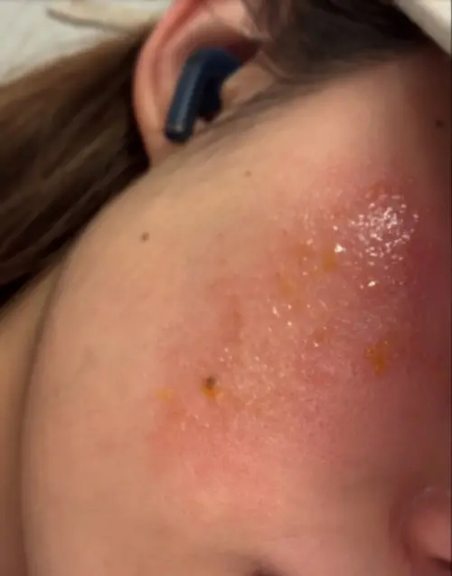 ▲黃婧靈敷面膜竟差點毀容！曝光臉部超慘近況　親吐病情：像十級火災。（圖／黃婧靈IG）