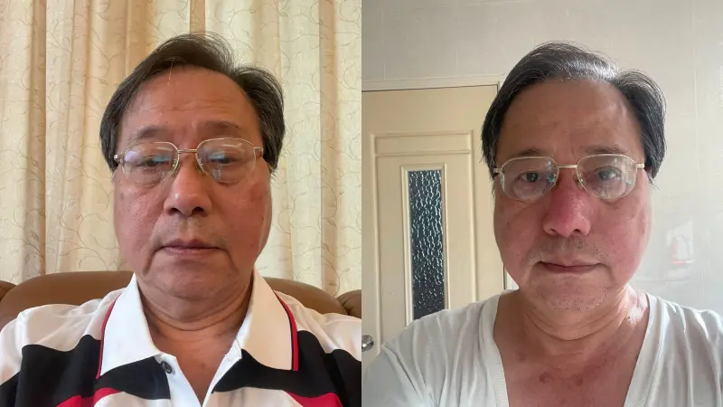 自嘲像豬八戒！李來希「2度遭蜂螫」慘照曝：腫到人臉辨識失敗