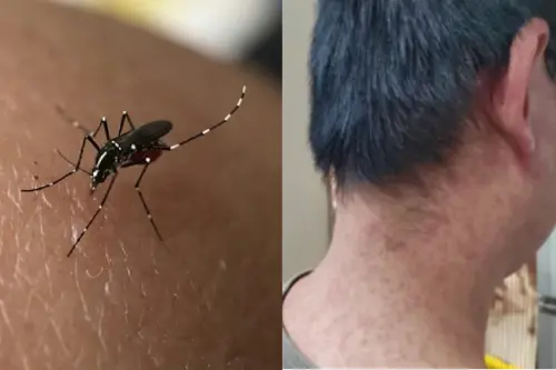 屈公病恐釀國內大規模流行？疾管署澄清：不會人傳人
