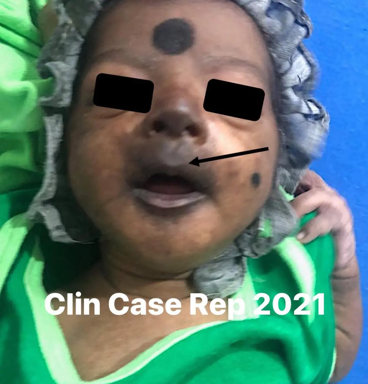 ▲一名出生僅12天大男嬰臉部變黑，經多項檢查後發現，其血液中的屈公病 IgM 抗體呈現陽性（表示正處於急性感染期）。（圖／翻攝自「來講兒科急診的543-吳昌騰醫師」臉書粉專）