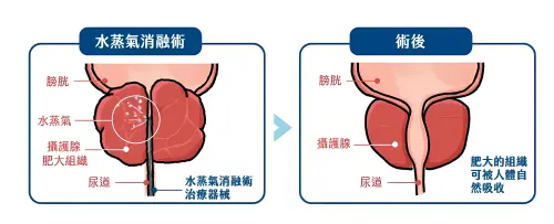 ▲攝護腺水蒸氣微創消融手術治療原理示意圖。（圖／長庚醫院提供）