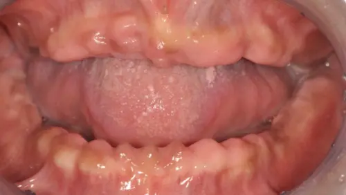 她50歲就全口無牙！植體支持性固定假牙重建　外觀功能都接近真牙
