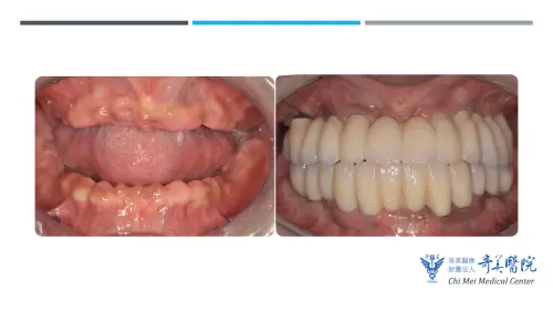 ▲50歲患者全口無牙又拒戴活動假牙，採用「植體支持性固定式假牙」成功重建。（圖／奇美醫院提供）