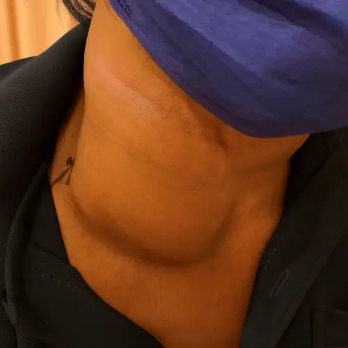 ▲罹患惡性淋巴癌的患者，頸部腫瘤十分明顯。（圖／醫院提供）