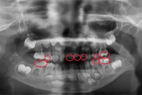 5歲男童牙痛臉腫！引爆蜂窩性組織炎　醫籲家長落實「5大護齒法」
